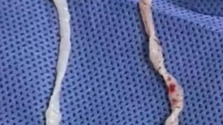 Viral! Dokter Operasi Benjolan di Lengan – Ternyata Isinya Cacing yang Sudah Hidup Selama 1 Tahun