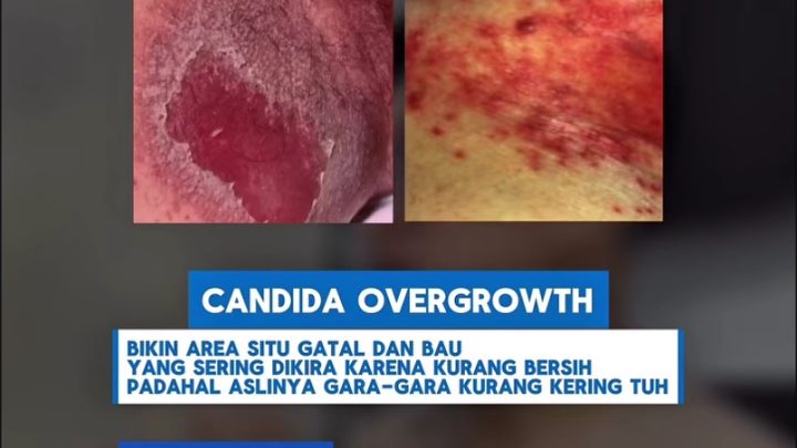 Key Issue: Ngeri! Cebok Enggak Bersih Picu Jamur di Area Selangkangan
