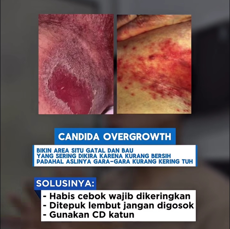 Ngeri! Cebok Enggak Bersih Picu Jamur di Area Selangkangan