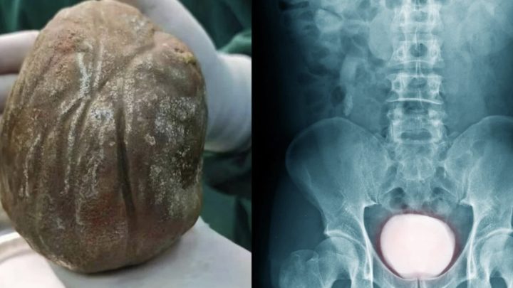 Ngeri! Cowok Ini Ngeluh Sakit Setiap Buang Air Kecil – Ternyata Ada Batu 1,3 Kg di Kandung Kemih