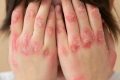 Key Discussion: Mengenal Lupus, Penyakit Autoimun yang Dijuluki Seribu Wajah