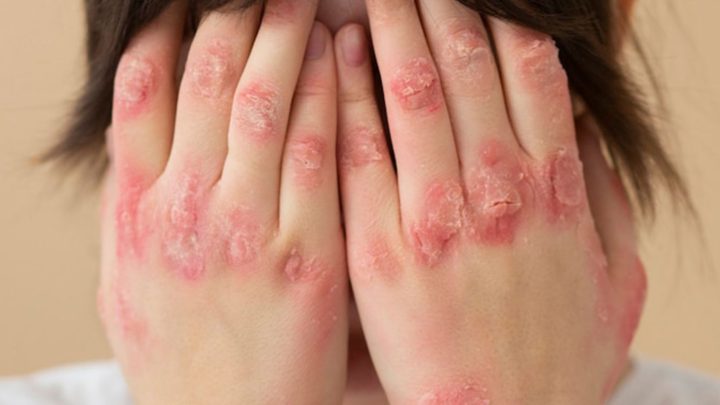 Key Discussion: Mengenal Lupus, Penyakit Autoimun yang Dijuluki Seribu Wajah