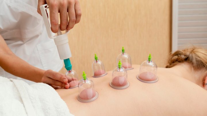 Dokter Ungkap Manfaat Bekam – Redakan Nyeri hingga Relaksasi Otot