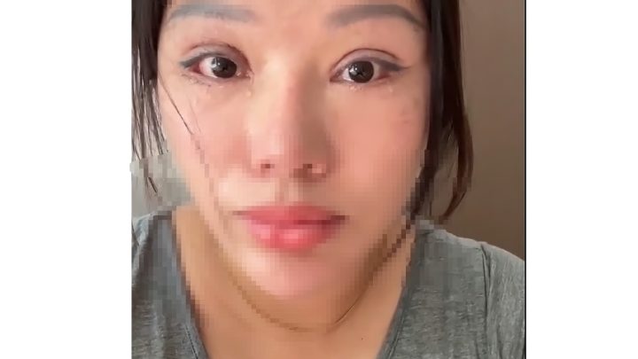 Solving Problems: Viral! Perempuan Ini Tidak Bisa Tidur dengan Mata Tertutup Gegara Oplas Gagal