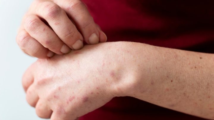 Gejala Bintik Merah Tak Berarti DBD – Bisa Jadi Penyakit Ini