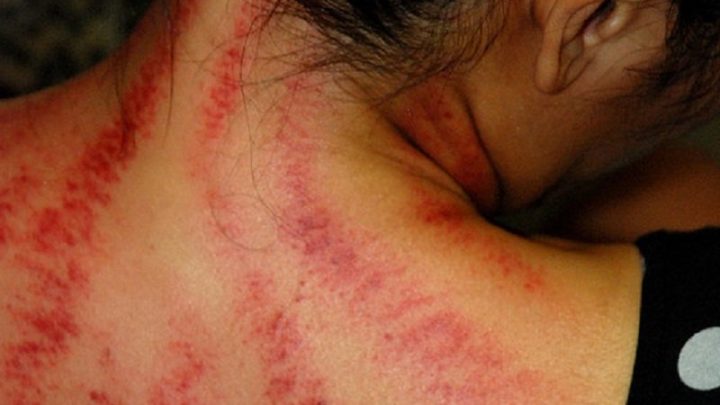 Benarkah Kerokan Sambil Tiduran Bisa Sebabkan Kematian?